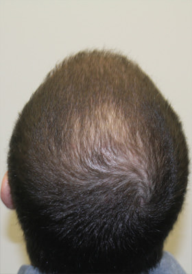 hair transplant before after Photos