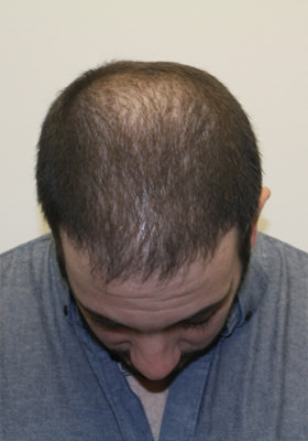 hair transplant before after Photos