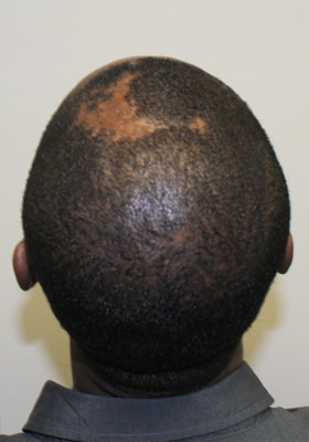 hair transplant before after Photos