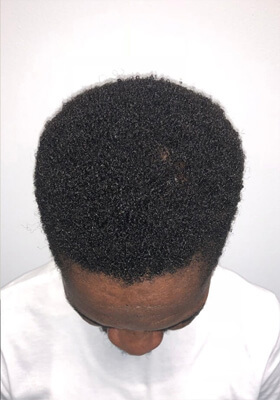 hair transplant photos