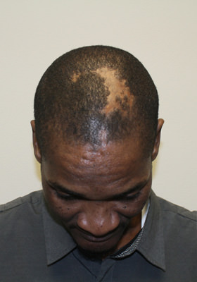 hair transplant photos