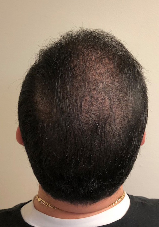 hair transplant before after Photos