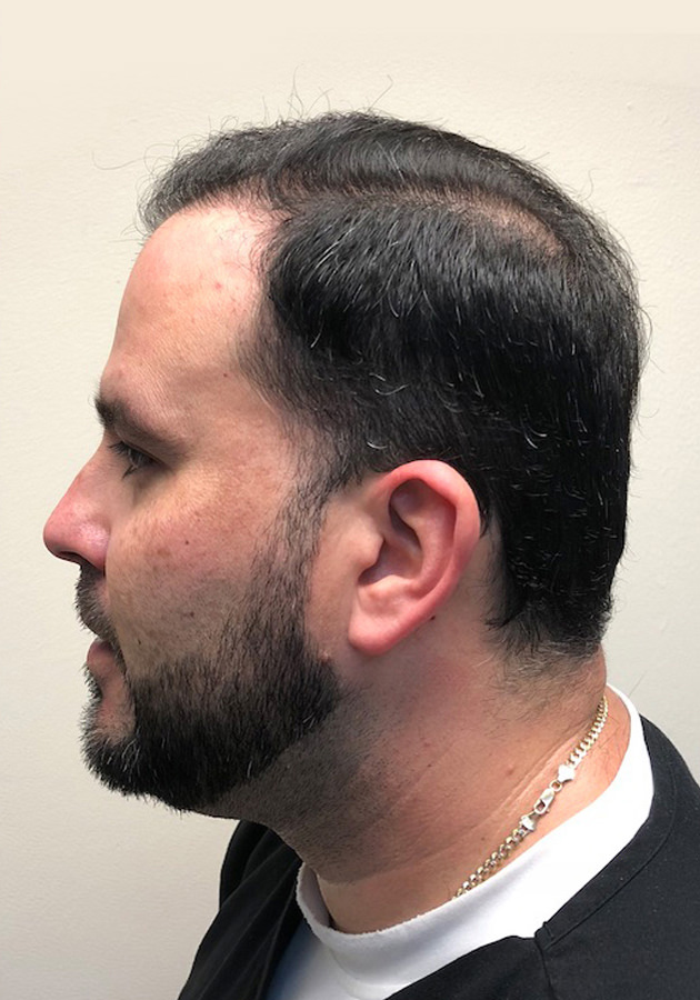 hair transplant before after Photos