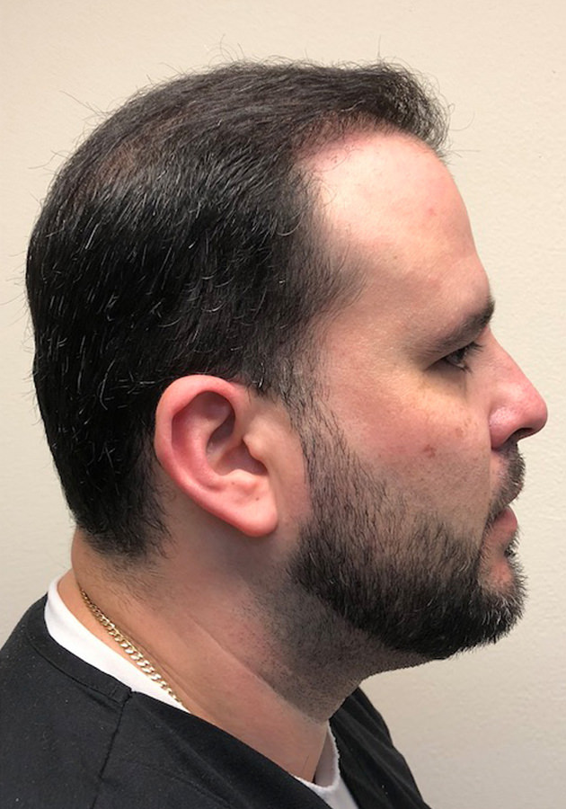 hair transplant before after Photos