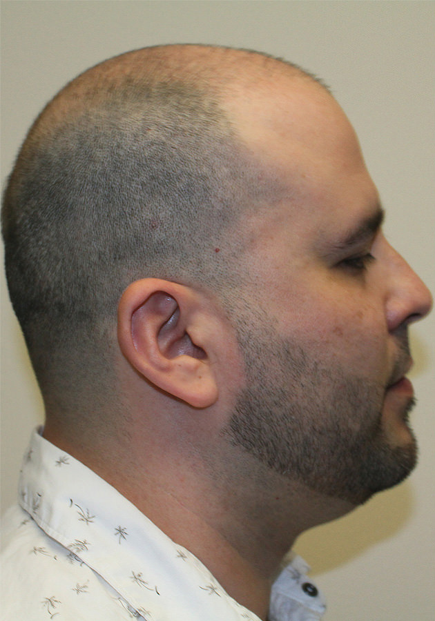 hair transplant before after Photos