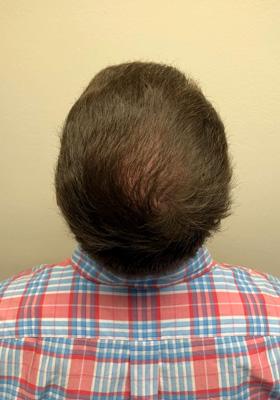 hair transplant before after Photos