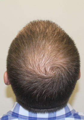 hair transplant before after Photos