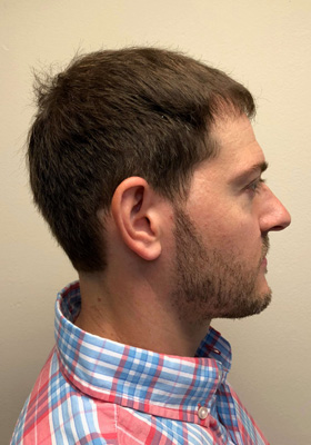 hair transplant before after Photos