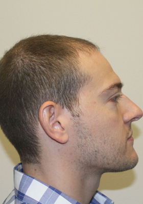 hair transplant before after Photos