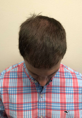 hair transplant before after Photos