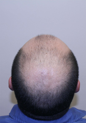 hair transplant before after Photos