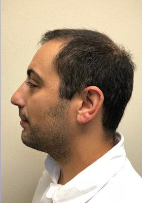 hair transplant before after Photos