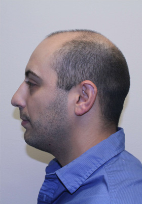 hair transplant before after Photos