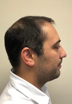 hair transplant before after Photos