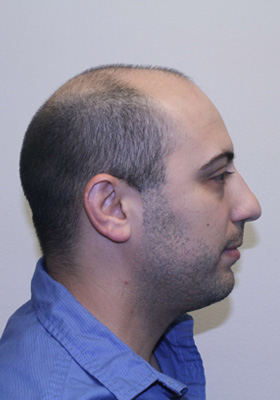 hair transplant before after Photos