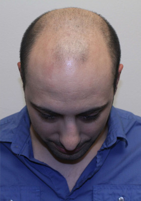 hair transplant before after Photos