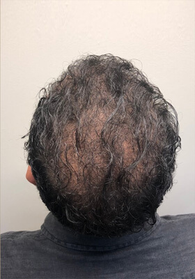 hair transplant before after Photos