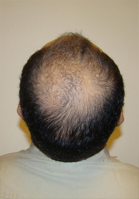 hair transplant before after Photos