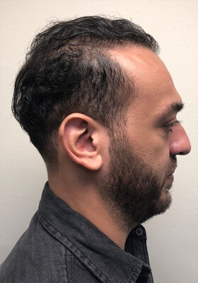 hair transplant before after Photos