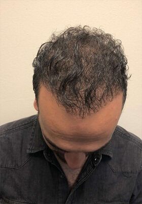 hair transplant photos