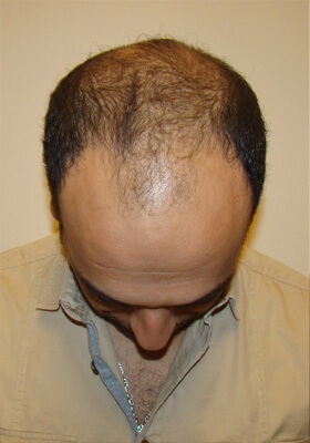 hair transplant before after Photos