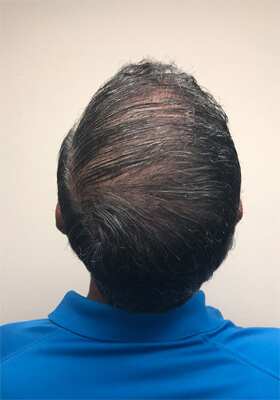 hair transplant before after Photos