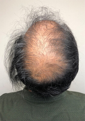 hair transplant before after Photos