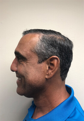 hair transplant before after Photos