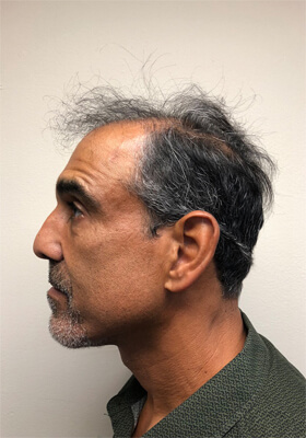 hair transplant before after Photos