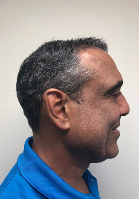 hair transplant before after Photos