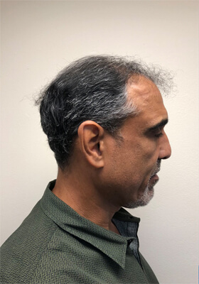 hair transplant before after Photos