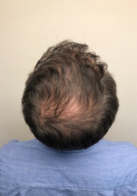 hair transplant before after Photos