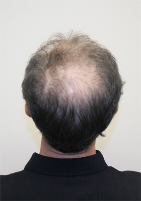 hair transplant before after Photos