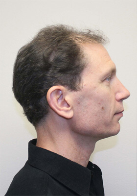 hair transplant before after Photos