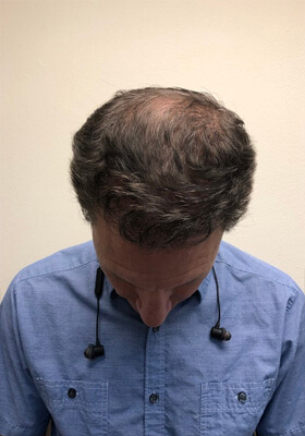 hair transplant before after Photos