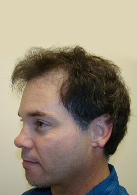 hair transplant before after Photos