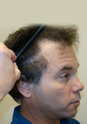 hair transplant photos