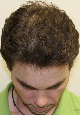 hair transplant before after Photos