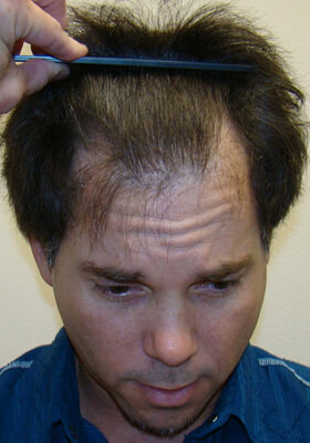 hair transplant before after Photos