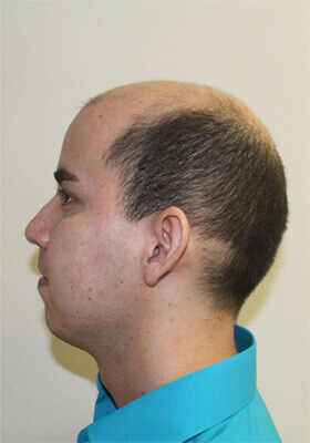 hair transplant before after Photos