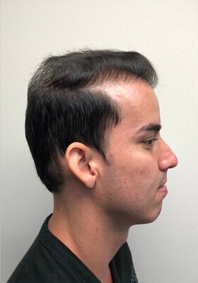 hair transplant before after Photos