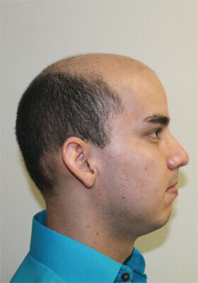 hair transplant before after Photos