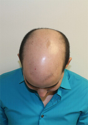 hair transplant before after Photos