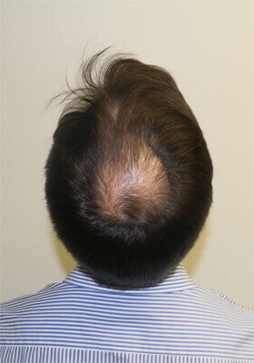 hair transplant before after Photos