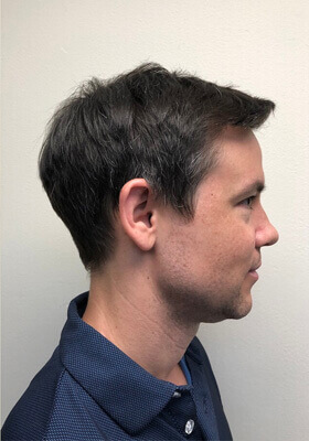 hair transplant before after Photos