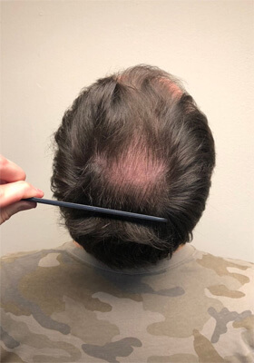 hair transplant before after Photos