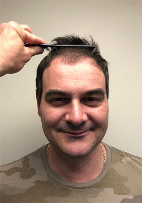 hair transplant before after Photos