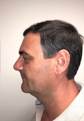 hair transplant before after Photos