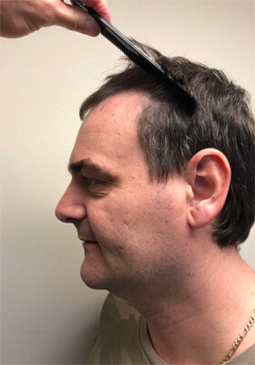 hair transplant before after Photos