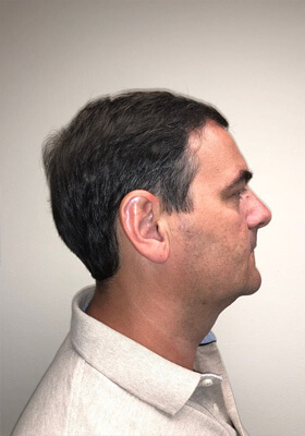 hair transplant before after Photos